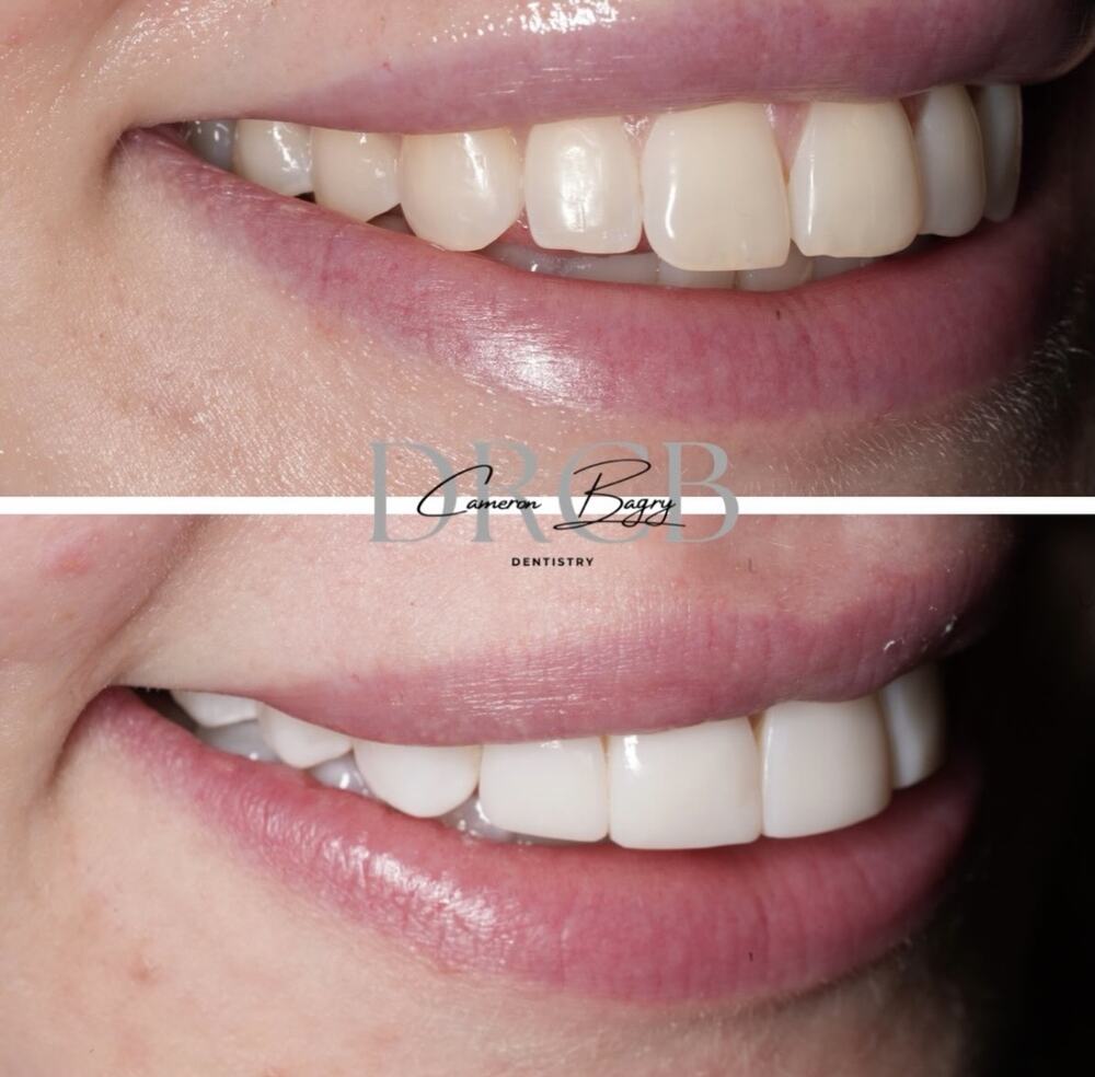 Before and after, composite bonding