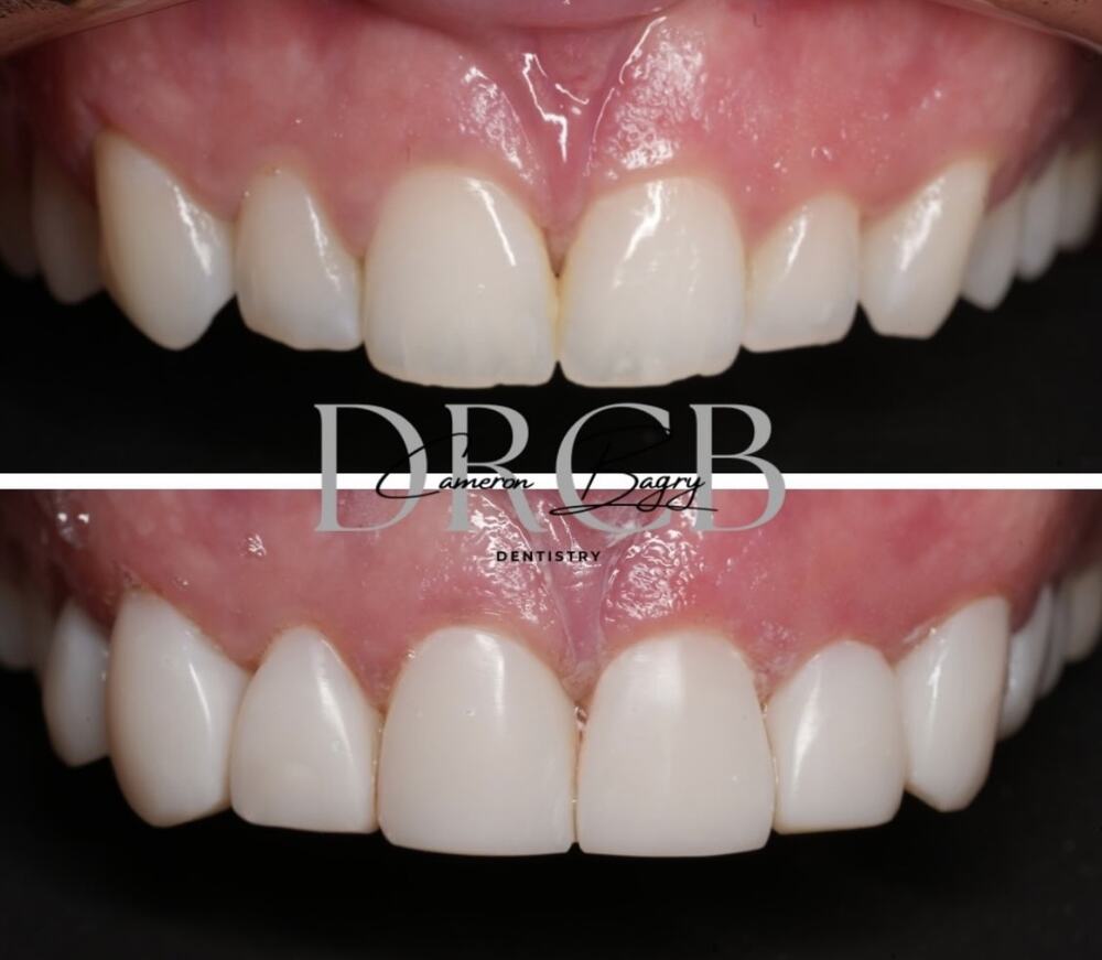 Before and after, composite bonding