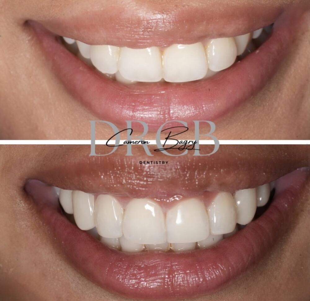Before and after, composite bonding