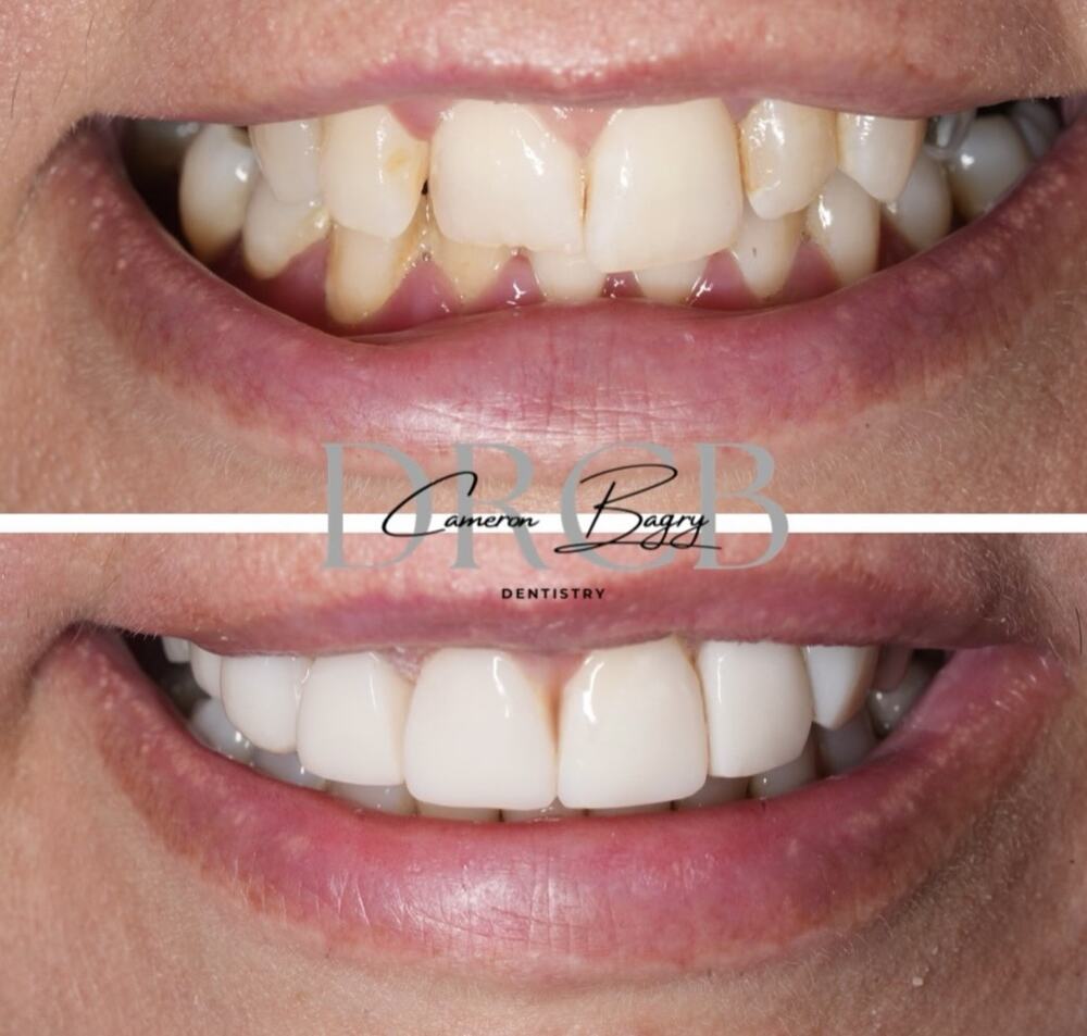 Before and after, composite bonding