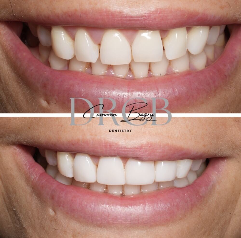 Before and after, composite bonding