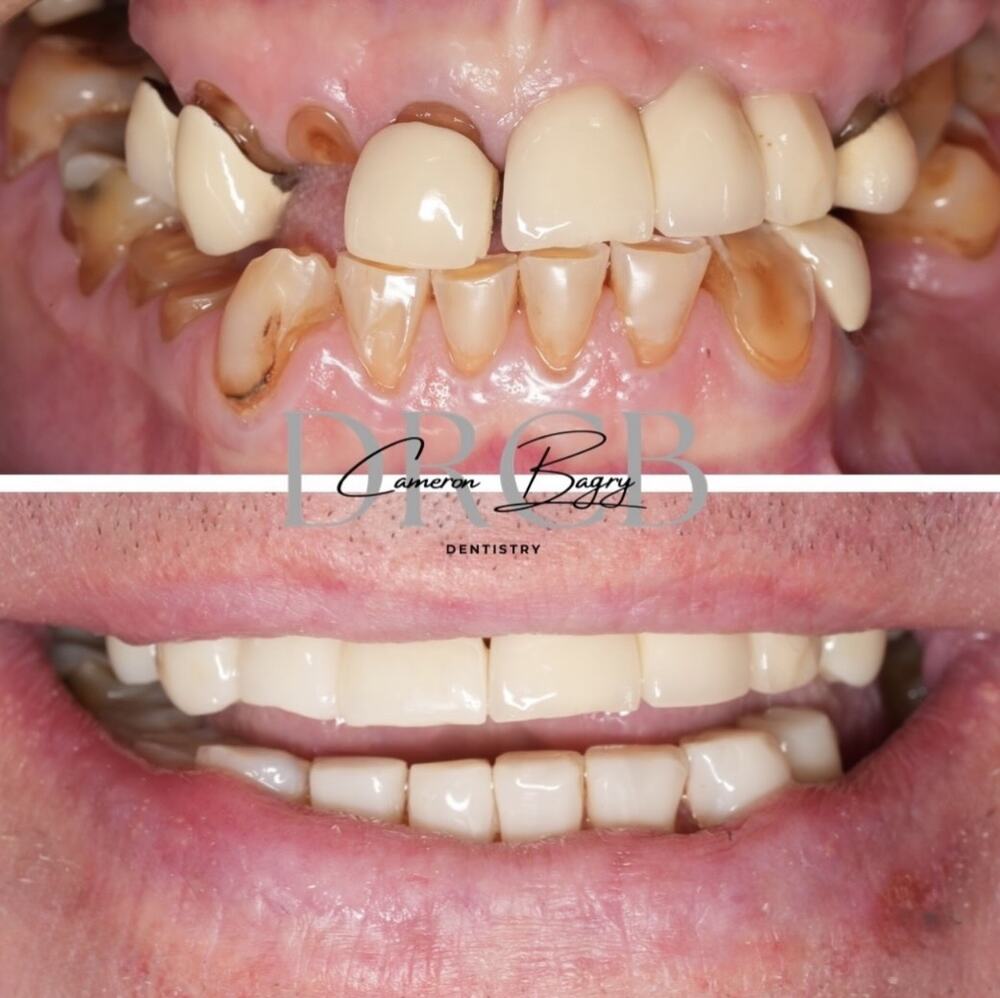 Before and after, full mouth rehabilitation