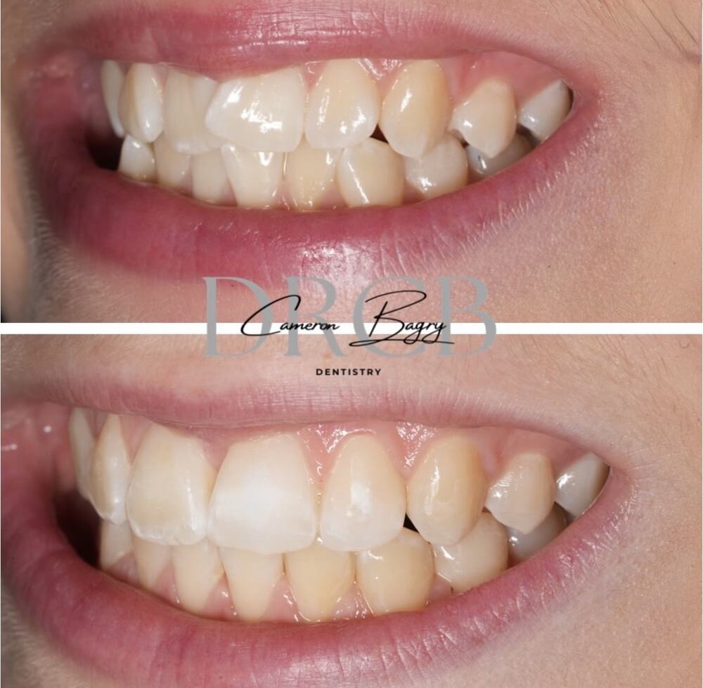 Before and after, Invisalign