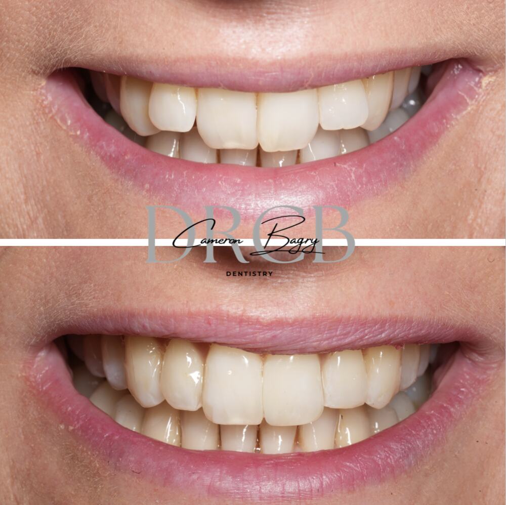 Before and after, Invisalign
