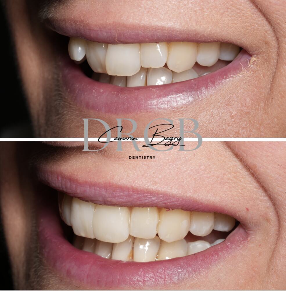 Before and after, Invisalign