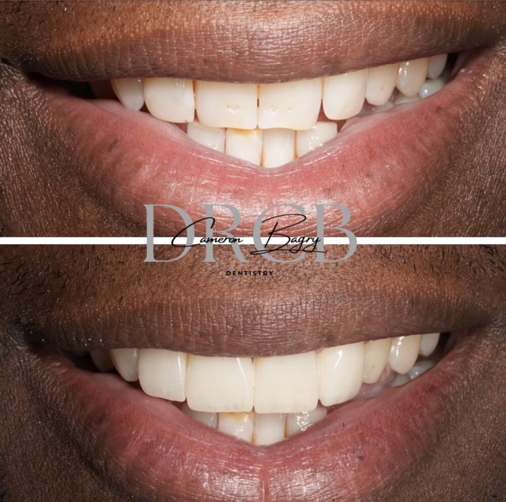 Before and after, prep-less veneers